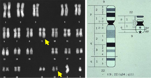 慢性骨髄性白血病(CML)の染色体異常 t(9;22)