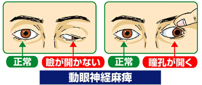 動眼神経麻痺