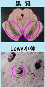 Lewy小体
