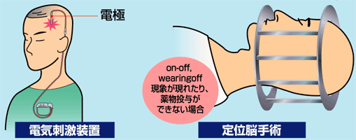 電気刺激装置・定位脳手術