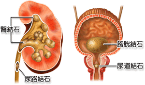 尿路結石