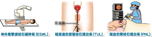 尿路結石の治療