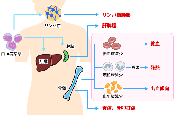 遺伝子変異のあるAMLタイプ