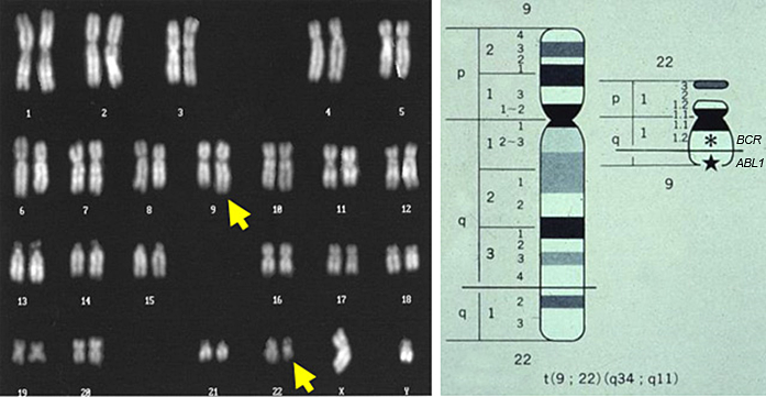 慢性骨髄性白血病(CML)の染色体異常 ｔ(9;22)