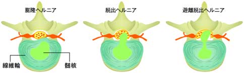 ヘルニア腫瘤の形態