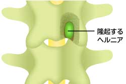 隆起するヘルニア