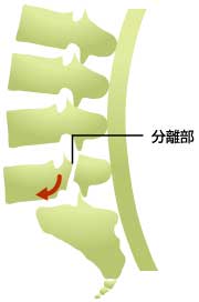 腰椎分離辷り症
