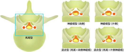 腰部脊柱管狭窄の神経障害形式