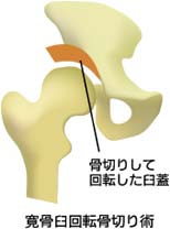 寛骨臼回転骨切り術