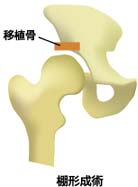 棚形成術
