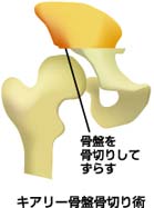 キアリー骨盤骨切り術