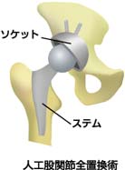 人工股関節全置換術