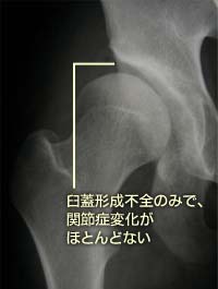 前股関節症