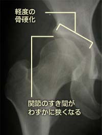 変形性股関節症初期
