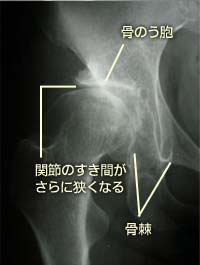 変形性股関節症進行期