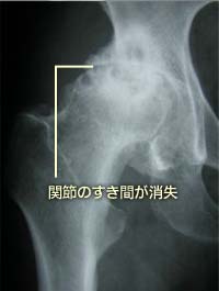 変形性股関節症末期