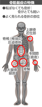 骨粗鬆症　骨折しやすい場所