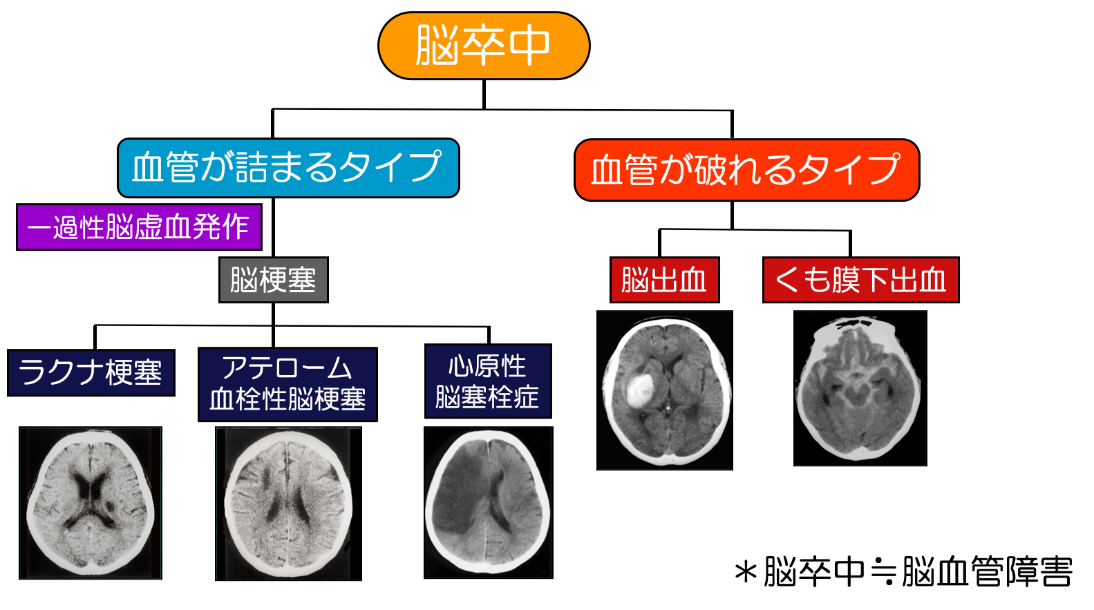 脳幹 出血