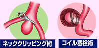 ネッククリッピング術/コイル塞栓術