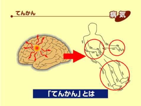 てんかんとは