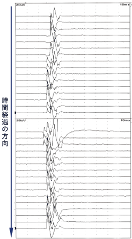 運動誘発電位のモニタリング