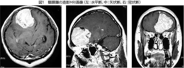 図1　髄膜腫の造影MRI画像