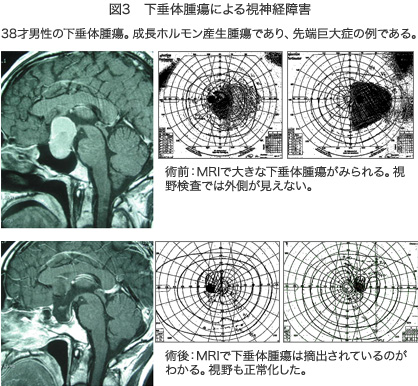 図3 下垂体腫瘍による視神経障害