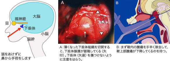 図4　下垂体腫瘍の手術