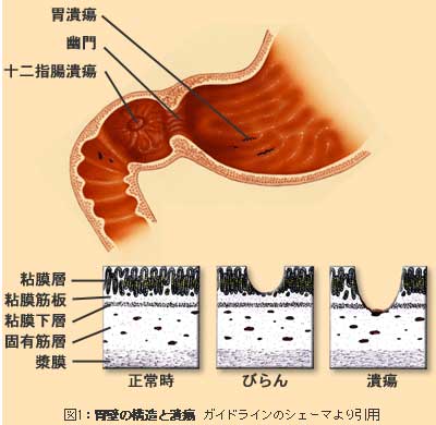 胃壁の構造と潰瘍