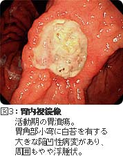 活動期の胃潰瘍