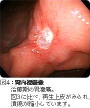 治癒期の胃潰瘍