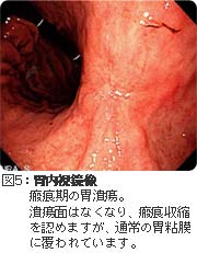 瘢痕期の胃潰瘍