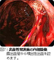 出血性胃潰瘍の内視鏡像