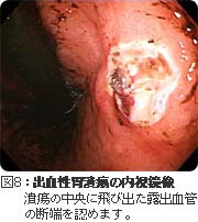 出血性胃潰瘍の内視鏡像