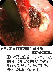 出血性胃潰瘍に対する高周波凝固法