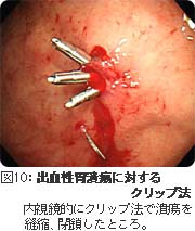 出血性胃潰瘍に対するクリップ法