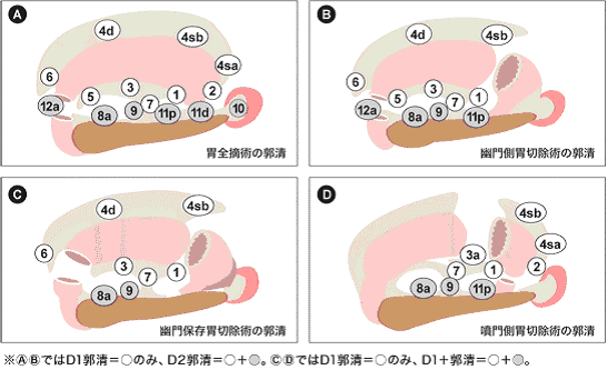 胃がん│標準医療情報センター