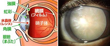 白内障