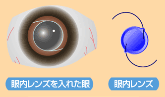 白内障の手術