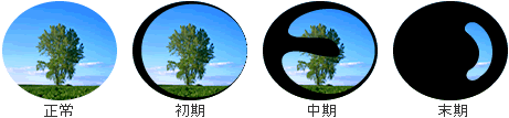 緑内障による視野の狭まり