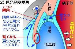 原発閉塞隅角