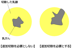 追加切除