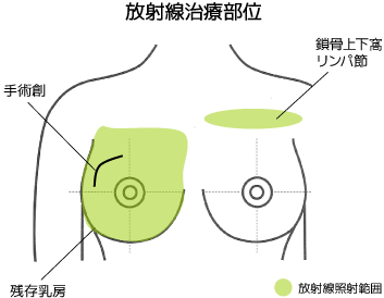 放射線治療部位