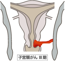 子宮頸がんIII期