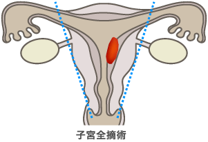 子宮全摘術