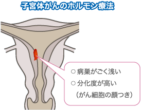 子宮体がんのホルモン療法
