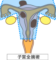 子宮全摘術
