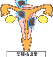 筋腫核出術