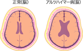 認知症の診断
