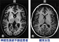 神経性食欲不振症